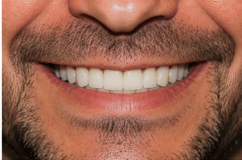 Patient after full arch restoration