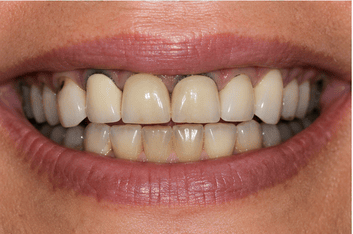 Patient teeth before treatment