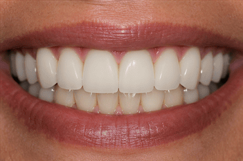 Patient teeth after zirconia bridge